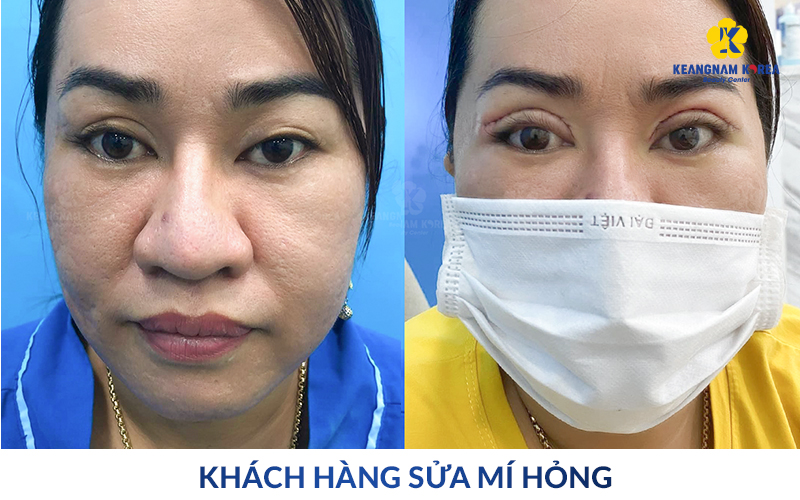 Top-Tier Blepharoplasty Revision in Ho Chi Minh City: Reclaiming Confidence at Keangnam Korea 8 Real Results From Keangnam Korea Clients