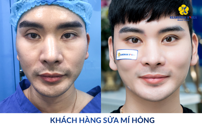 Top-Tier Blepharoplasty Revision in Ho Chi Minh City: Reclaiming Confidence at Keangnam Korea 9 Real Results From Keangnam Korea Clients