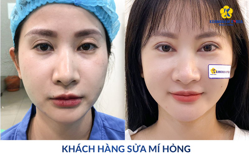 Top-Tier Blepharoplasty Revision in Ho Chi Minh City: Reclaiming Confidence at Keangnam Korea 10 Real Results From Keangnam Korea Clients