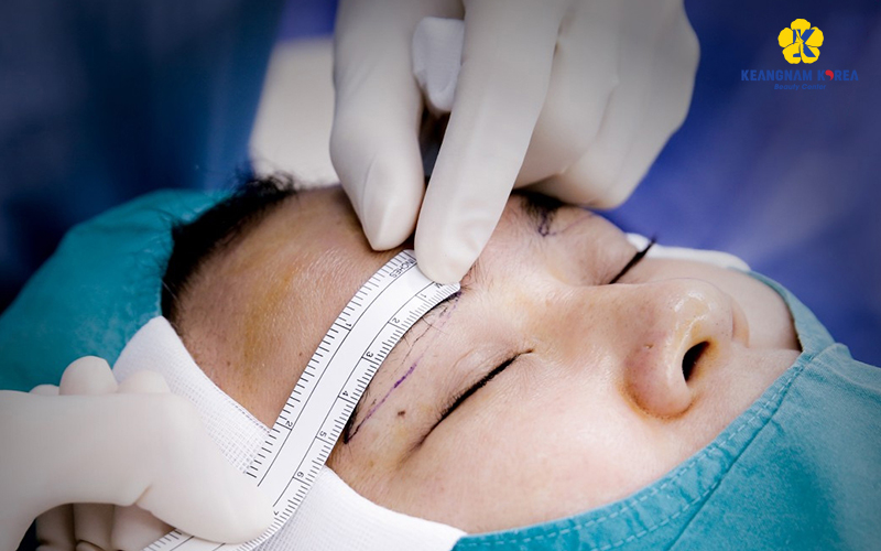 Top-Tier Blepharoplasty Revision in Ho Chi Minh City: Reclaiming Confidence at Keangnam Korea 4 Blepharoplasty Revision