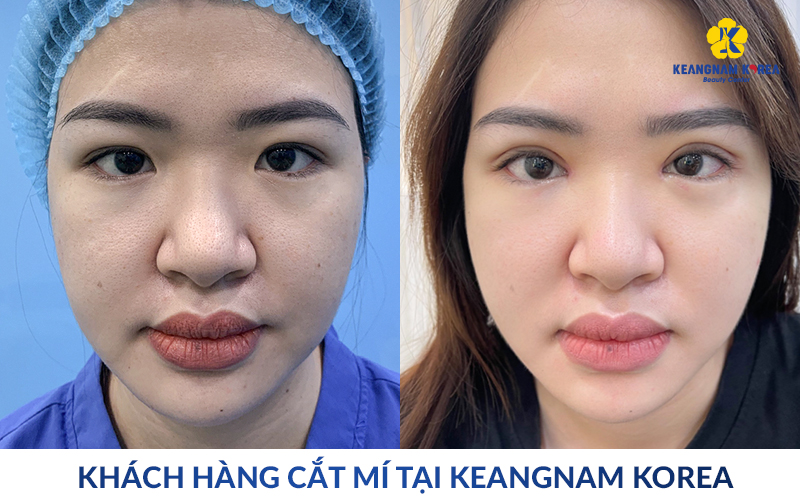 Eyelid Surgery in Ho Chi Minh City: Natural, Safe Double Eyelid Results at Keangnam Korea 12 eyelid surgery in ho chi minh city