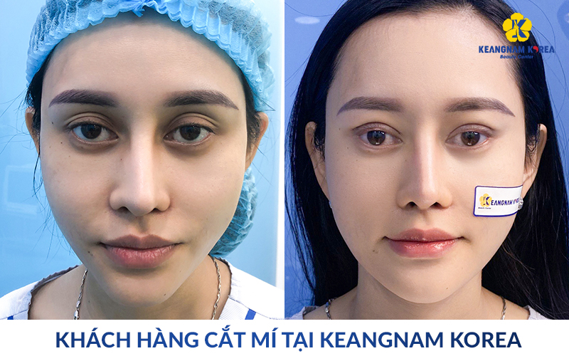 Eyelid Surgery in Ho Chi Minh City: Natural, Safe Double Eyelid Results at Keangnam Korea 10 eyelid surgery in ho chi minh city