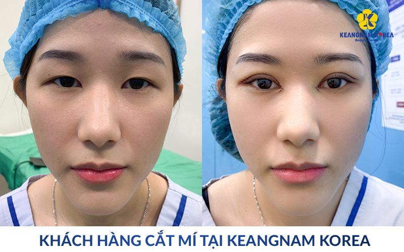 Eyelid Surgery in Ho Chi Minh City: Natural, Safe Double Eyelid Results at Keangnam Korea 11 eyelid surgery in ho chi minh city