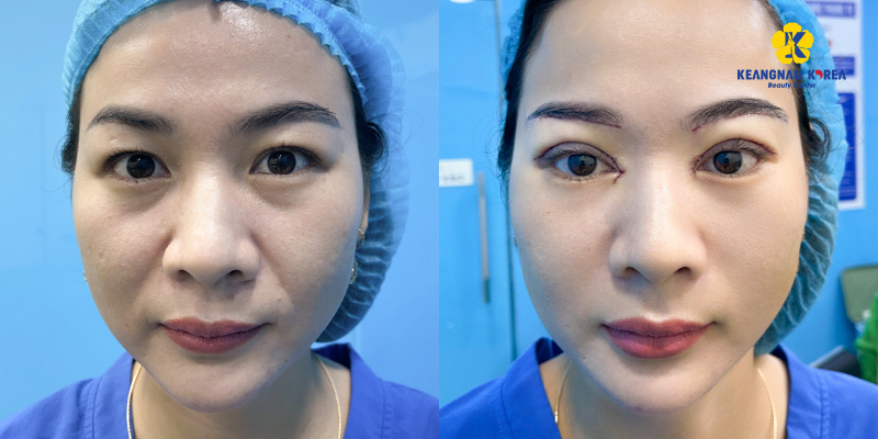 Eyelid Surgery Cost in Ho Chi Minh: The Ultimate Guide to 9 Blepharoplasty Procedures and Their Prices 7 Double Eyelid Surgery Cost