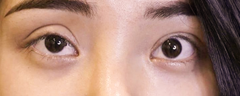Eyelid Retraction After Blepharoplasty: Signs, Causes & How to Correct It 2 Signs and Symptoms of Eyelid Retraction
