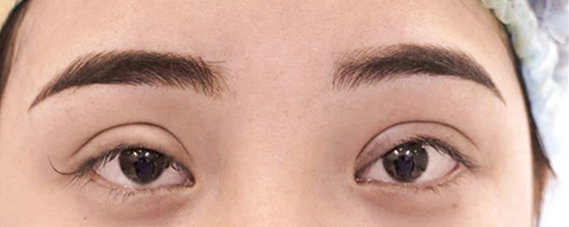Eyelid Retraction After Blepharoplasty: Signs, Causes & How to Correct It 3 Signs and Symptoms of Eyelid Retraction