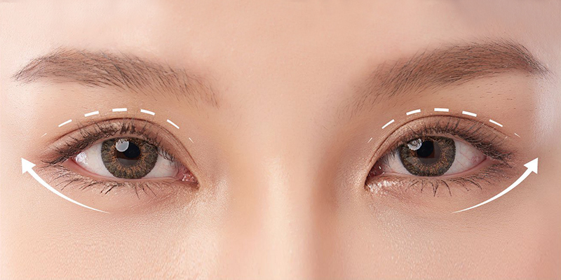 Eyelid Retraction After Blepharoplasty: Signs, Causes & How to Correct It 1 Eyelid Retraction After Blepharoplasty