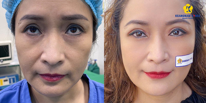 Eyelid Retraction After Blepharoplasty: Signs, Causes & How to Correct It 5 Where to Get Revision Blepharoplasty Safely