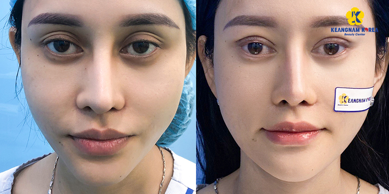 Eyelid Retraction After Blepharoplasty: Signs, Causes & How to Correct It 6 Where to Get Revision Blepharoplasty Safely