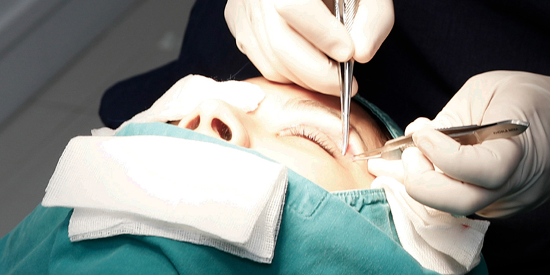 Eyelid Retraction After Blepharoplasty: Signs, Causes & How to Correct It 4 How to Fix Eyelid Retraction After Surgery