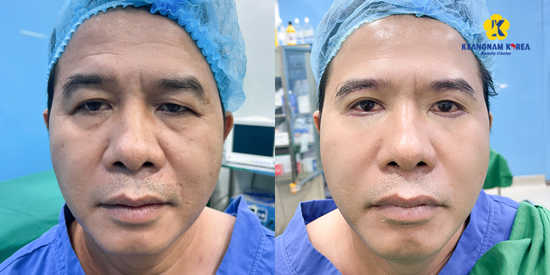 Eyelid Surgery Cost in Ho Chi Minh: The Ultimate Guide to 9 Blepharoplasty Procedures and Their Prices 6 Lower Blepharoplasty Cost
