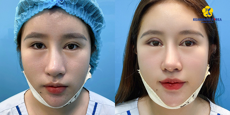 Eyelid Surgery Cost in Ho Chi Minh: The Ultimate Guide to 9 Blepharoplasty Procedures and Their Prices 4 Upper Blepharoplasty Cost