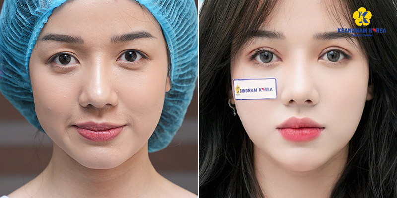 Eyelid Surgery Cost in Ho Chi Minh: The Ultimate Guide to 9 Blepharoplasty Procedures and Their Prices 5 Upper Eyelid Fat Removal Cost