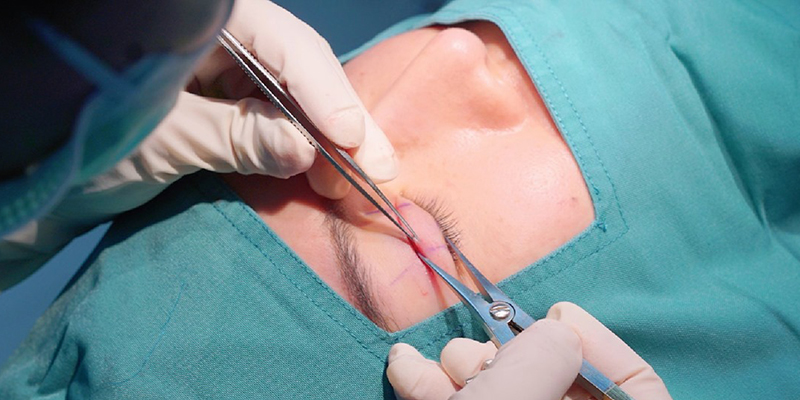 Eyelid Surgery Cost in Ho Chi Minh: The Ultimate Guide to 9 Blepharoplasty Procedures and Their Prices 10 Eyelid Surgery at Keangnam Korea