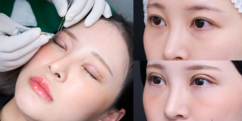 Eyelid Surgery Cost in Ho Chi Minh: The Ultimate Guide to 9 Blepharoplasty Procedures and Their Prices 11 Eyelid Surgery in ho chi minh