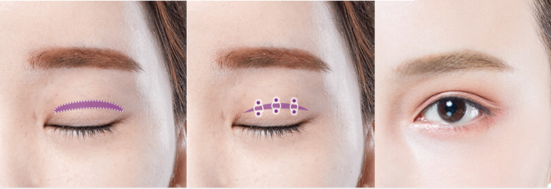 Double Eyelid Surgery: What It Is, Should You Get It, and the best eyelid clinic in Ho Chi Minh City 2 Double Eyelid Surgery
