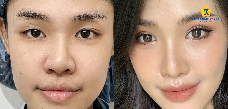 Double Eyelid Surgery: What It Is, Should You Get It, and the best eyelid clinic in Ho Chi Minh City 3 Double Eyelid Surgery