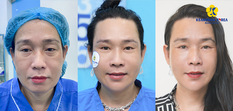 Double Eyelid Surgery: What It Is, Should You Get It, and the best eyelid clinic in Ho Chi Minh City 4 Double Eyelid Surgery