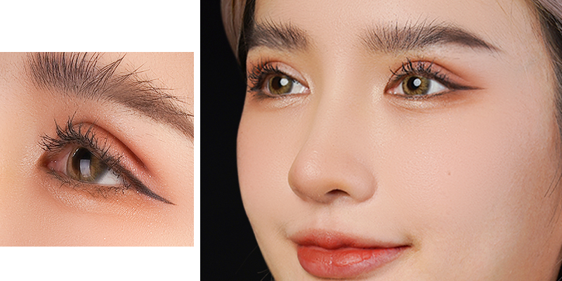 Double Eyelid Surgery: What It Is, Should You Get It, and the best eyelid clinic in Ho Chi Minh City 1 Double Eyelid Surgery