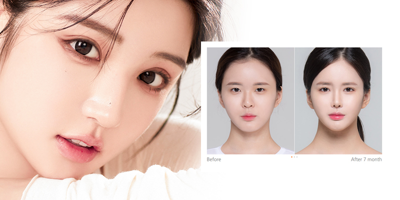 Eyelid Surgery Cost in Ho Chi Minh: The Ultimate Guide to 9 Blepharoplasty Procedures and Their Prices 1 Eyelid Surgery Cost in Ho Chi Minh