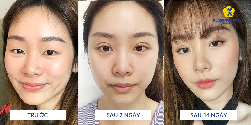 Eyelid Surgery Recovery Time Abroad: How Soon Can You Fly? 2 Eyelid Surgery Recovery Time Abroad