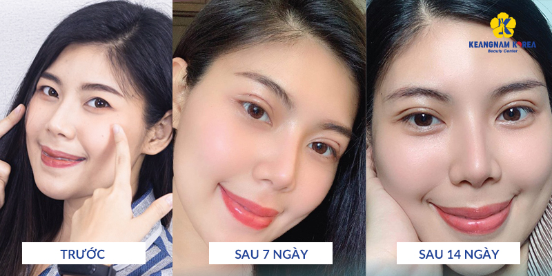 Eyelid Surgery Recovery Time Abroad: How Soon Can You Fly? 3 Eyelid Surgery Recovery Time Abroad
