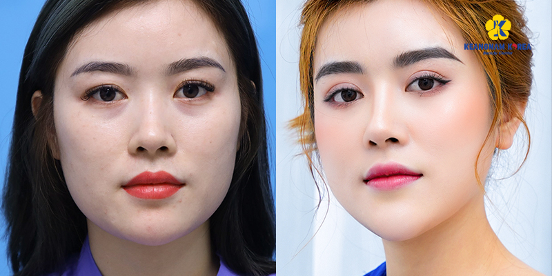 Eyelid Surgery Recovery Time Abroad: How Soon Can You Fly? 5 Eyelid Surgery Recovery Time Abroad