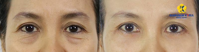 Hình ảnh trước và sau cắt mỡ bọng mắt