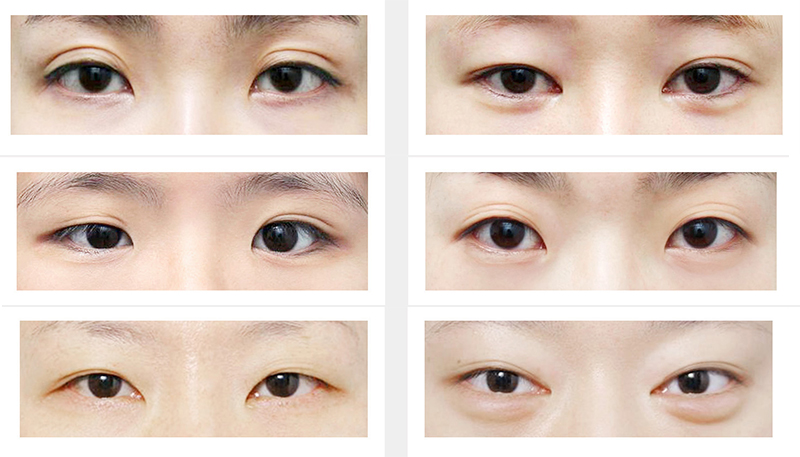What Is Korean Double Eyelid Surgery? Pros, Cons, and Cost in Vietnam, 2026 2 What Is Korean Double Eyelid Surgery