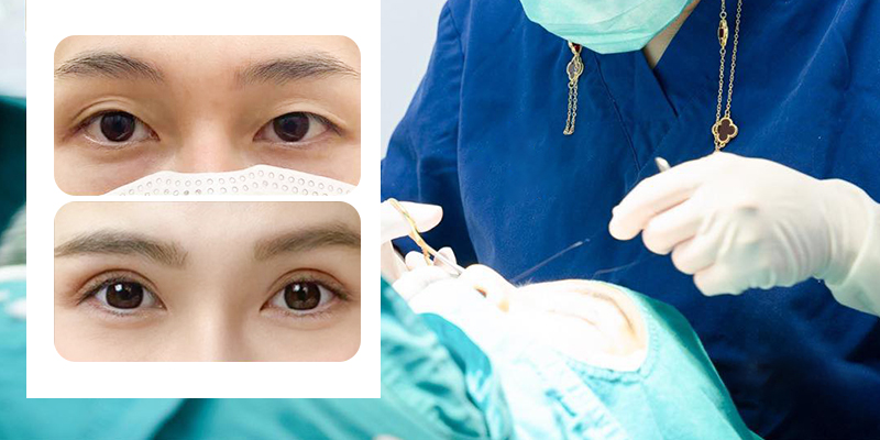 What Is Korean Double Eyelid Surgery? Pros, Cons, and Cost in Vietnam, 2026 3 What Is Korean Double Eyelid Surgery