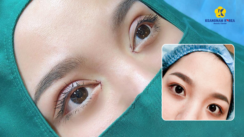 What Is Korean Double Eyelid Surgery? Pros, Cons, and Cost in Vietnam, 2026 5 What Is Korean Double Eyelid Surgery