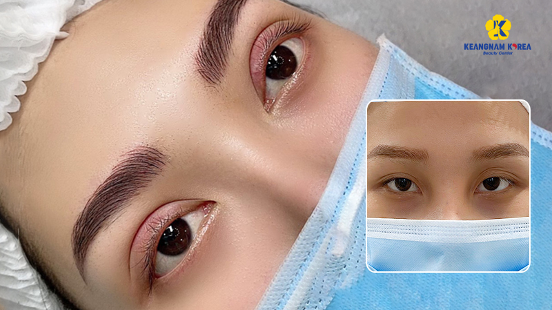 What Is Korean Double Eyelid Surgery? Pros, Cons, and Cost in Vietnam, 2026 6 What Is Korean Double Eyelid Surgery