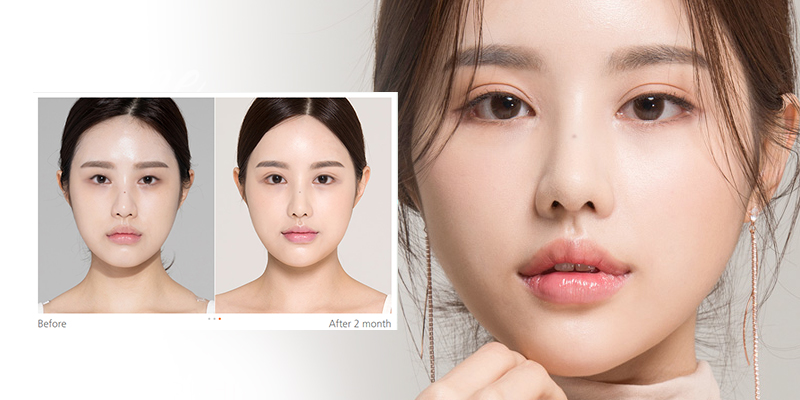 What Is Korean Double Eyelid Surgery? Pros, Cons, and Cost in Vietnam, 2026 1 What Is Korean Double Eyelid Surgery