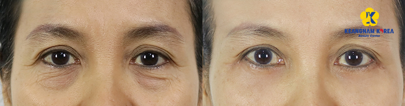 Lower Eyelid Bag Removal In Ho Chi Minh: Benefits, 2026 Costs, and Clinical Guide 5 lower eyelid bag removal before and after