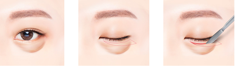 Lower Eyelid Bag Removal In Ho Chi Minh: Benefits, 2026 Costs, and Clinical Guide 4 lower eyelid bag removal procedure