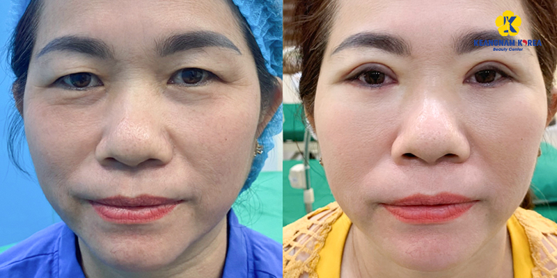 Lower Eyelid Bag Removal In Ho Chi Minh: Benefits, 2026 Costs, and Clinical Guide 1 lower eyelid bag removal