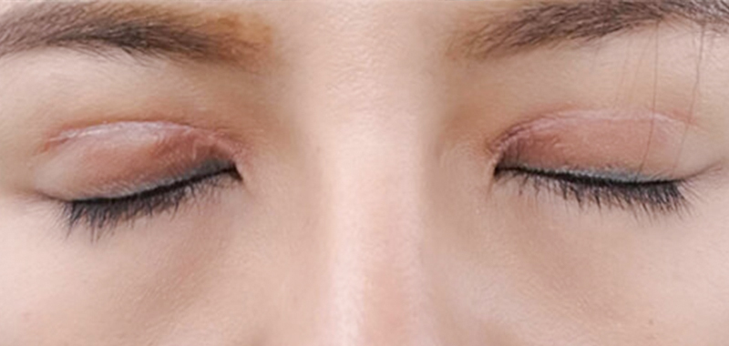 Revision Blepharoplasty at Keangnam Korea: Restoring Beautiful Eyes After Botched Eyelid Surgery 2 botched eyelid surgery