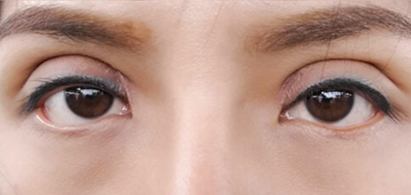 Revision Blepharoplasty at Keangnam Korea: Restoring Beautiful Eyes After Botched Eyelid Surgery 3 bad blepharoplasty