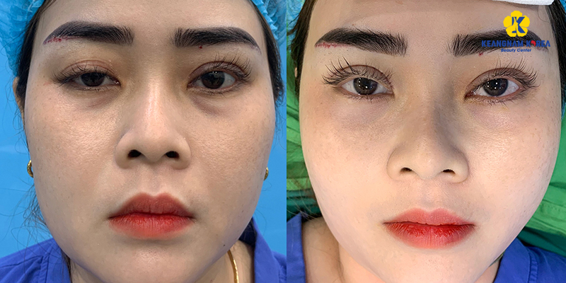 Revision Blepharoplasty at Keangnam Korea: Restoring Beautiful Eyes After Botched Eyelid Surgery 6 revision blepharoplasty