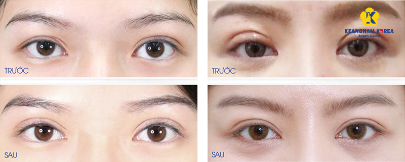Revision Blepharoplasty at Keangnam Korea: Restoring Beautiful Eyes After Botched Eyelid Surgery 7 can a bad blepharoplasty be corrected?