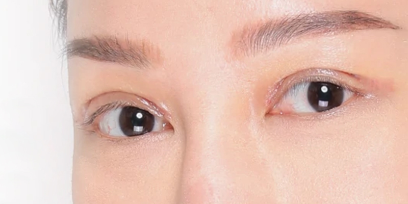 Revision Blepharoplasty at Keangnam Korea: Restoring Beautiful Eyes After Botched Eyelid Surgery 1 Revision Blepharoplasty