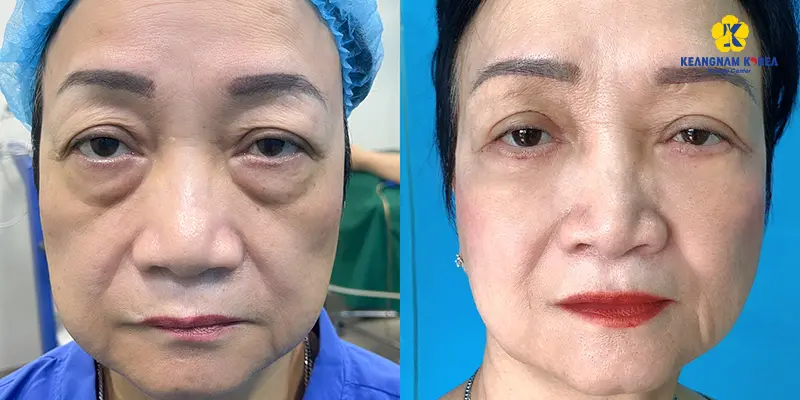 Transconjunctival Blepharoplasty: What Does It Do and Will the Fat Come Back? 3 Who Should Consider Transconjunctival Lower Blepharoplasty