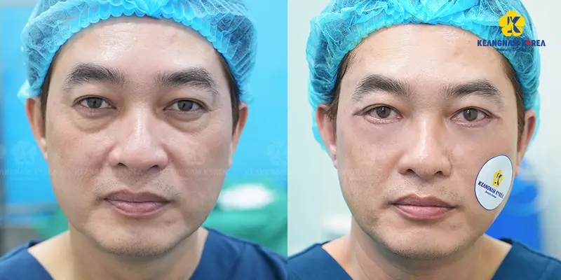 Transconjunctival Blepharoplasty: What Does It Do and Will the Fat Come Back? 4 Who Should Consider Transconjunctival Blepharoplasty