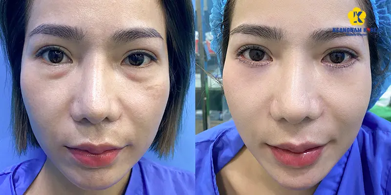 Transconjunctival Blepharoplasty: What Does It Do and Will the Fat Come Back? 2 Who Should Consider Transconjunctival Lower Blepharoplasty
