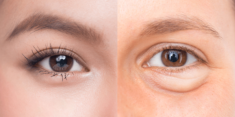 Transconjunctival Blepharoplasty: What Does It Do and Will the Fat Come Back? 1 What Is Transconjunctival Blepharoplasty?