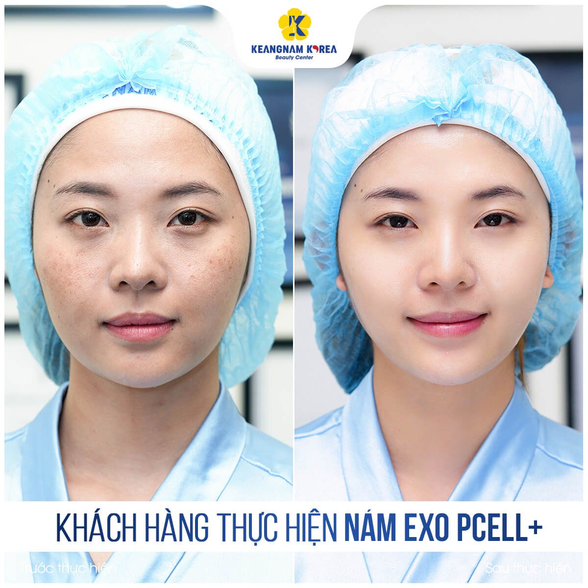 BF_AF_khach-hang-tri-nam-exo-pcell-1