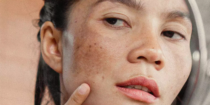 Where to Treat Facial Melasma and Freckles Quickly
