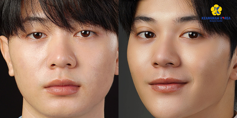 Upper & Lower Male Eyelid Surgery in Ho Chi Minh: Cost, Forms, Methods, Recovery Time and Important Notes 2 Should Men Get Eyelid Surgery
