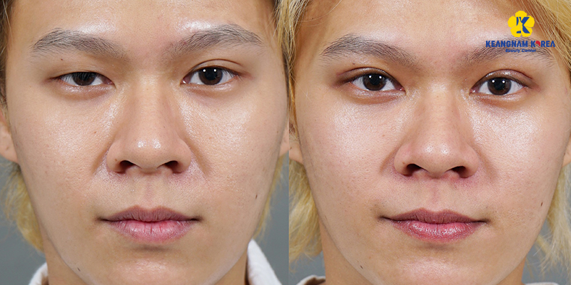 Upper & Lower Male Eyelid Surgery in Ho Chi Minh: Cost, Forms, Methods, Recovery Time and Important Notes 3 top 3 Blepharoplasty Options