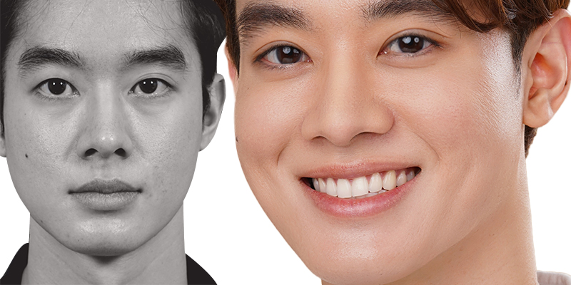 Upper & Lower Male Eyelid Surgery in Ho Chi Minh: Cost, Forms, Methods, Recovery Time and Important Notes 5 Where to Get Male Eyelid Surgery in Ho Chi Minh City